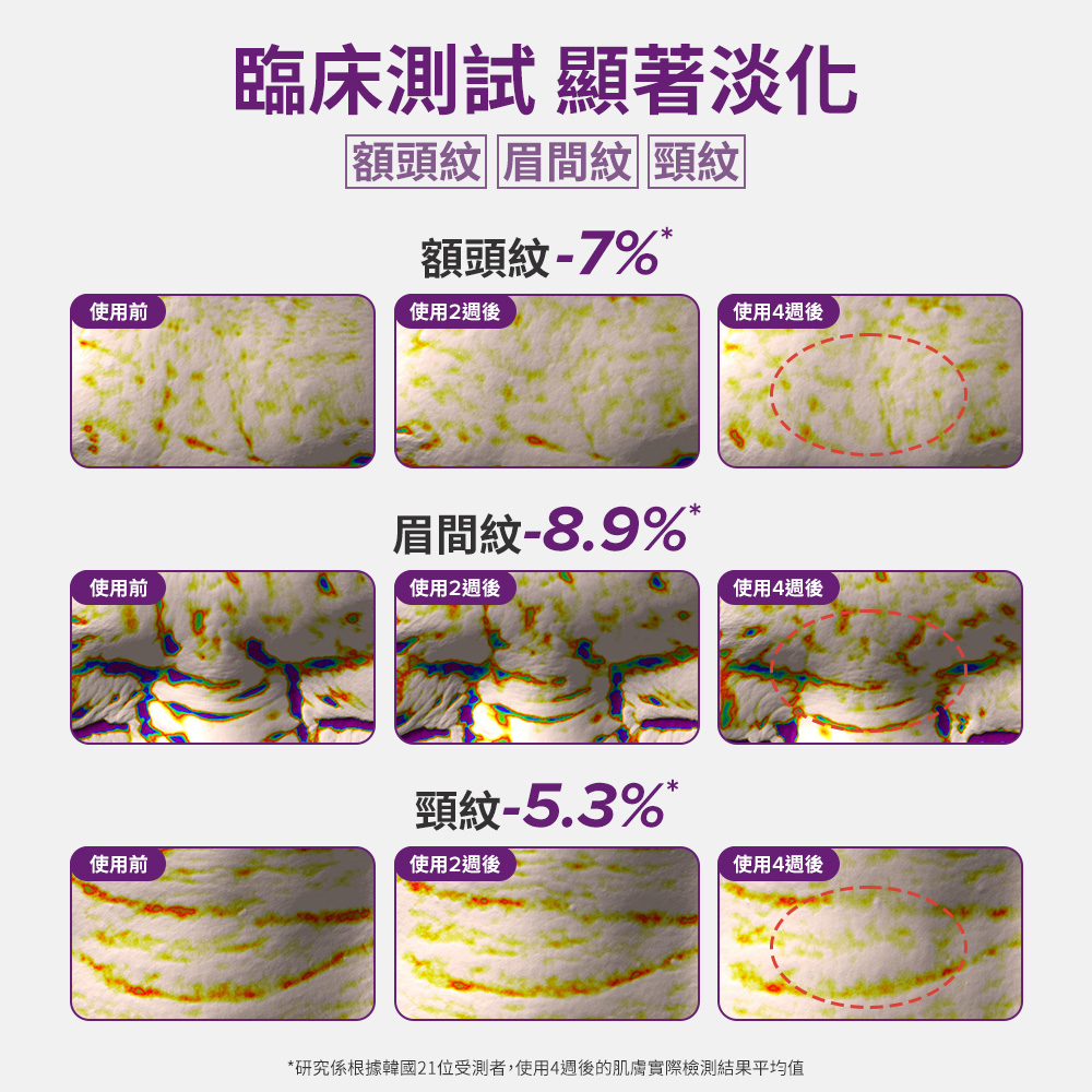 臨床測試 顯著淡化額頭紋、眉間紋、頸紋