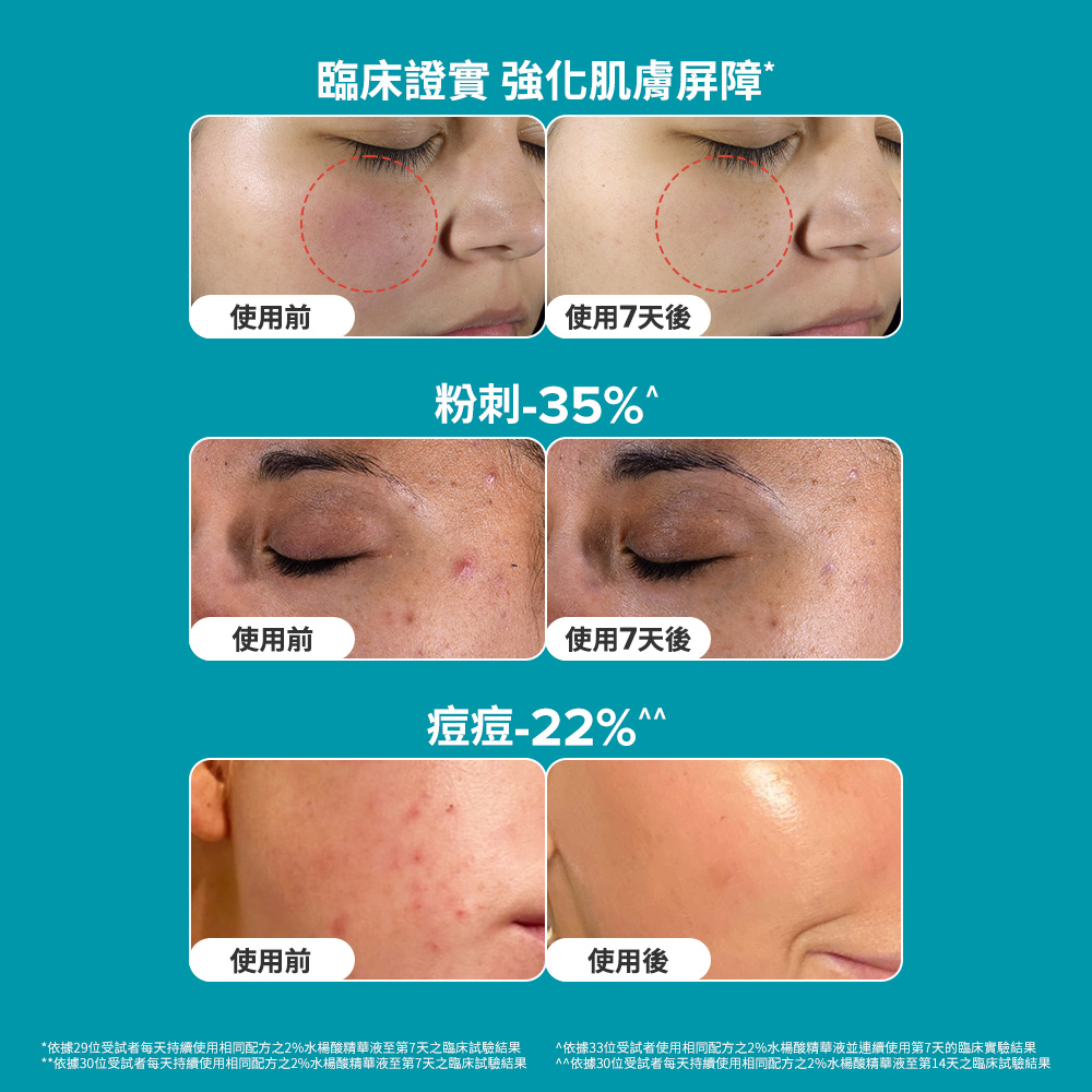 臨床證實 強化肌膚屏障 粉刺-35% 痘痘-22%