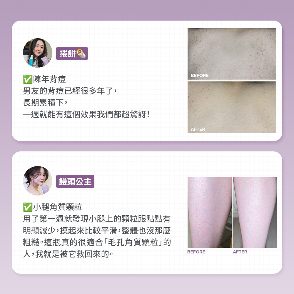 陳年背痘 小腿角質顆粒