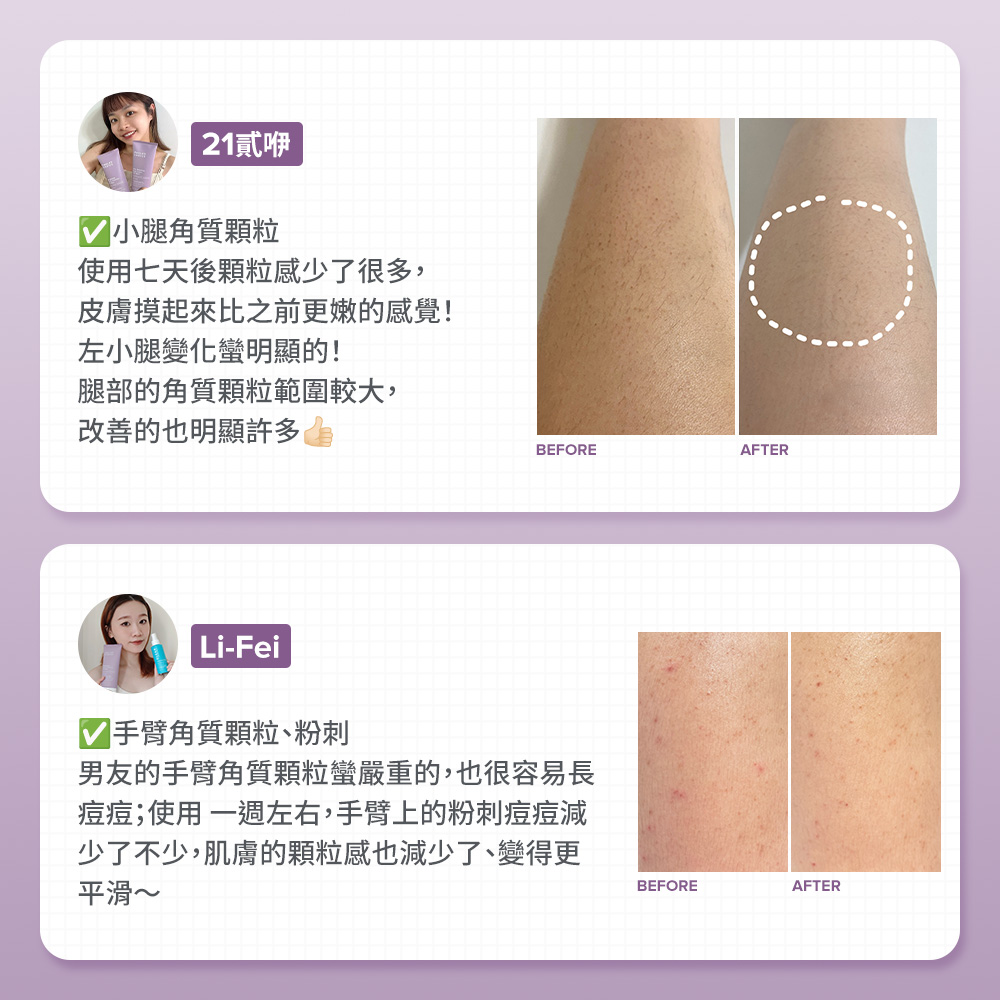 手臂角質顆粒、粉刺