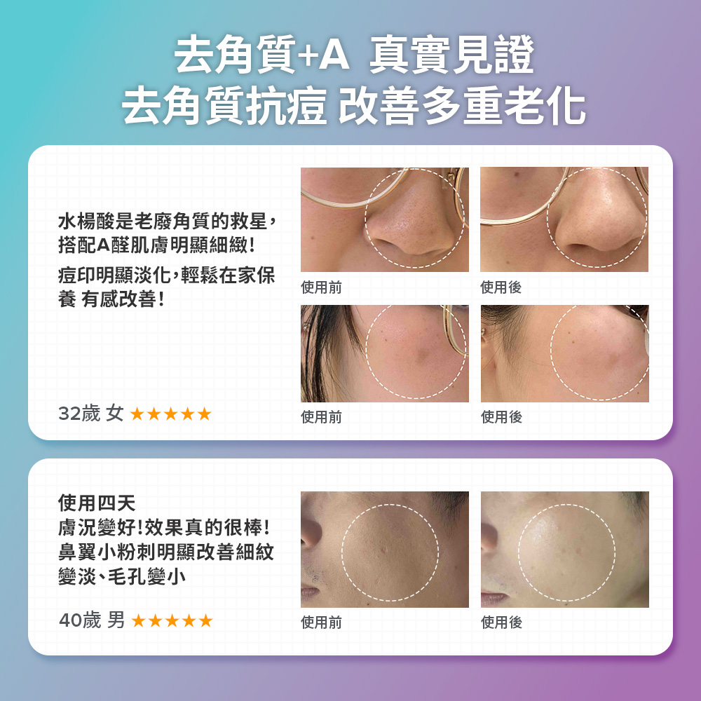 去角質+A 真實見證 去角質抗痘 改善多重老化