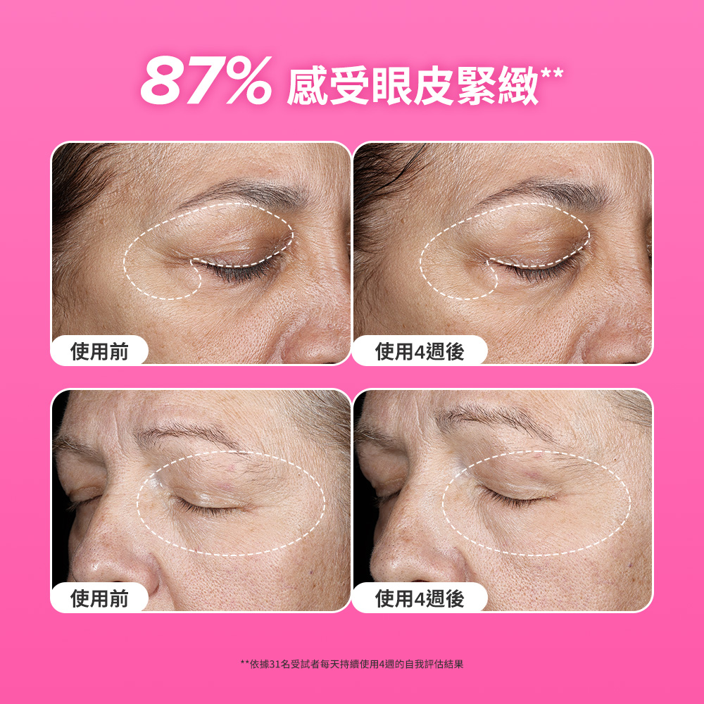 87% 感受眼皮緊緻