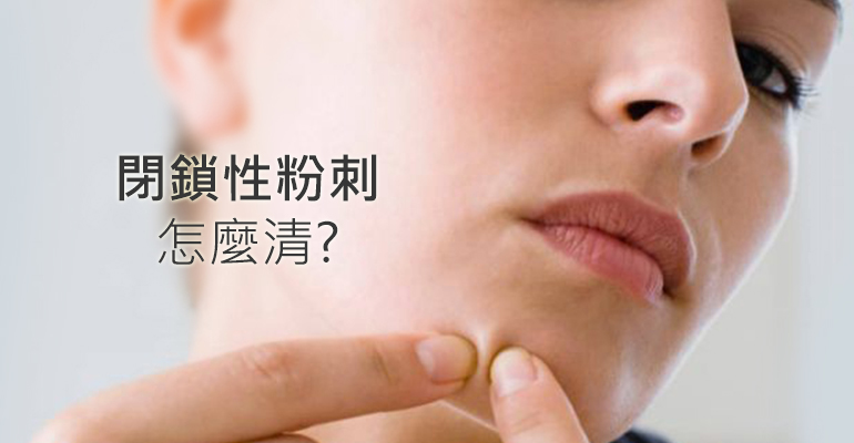 閉鎖性粉刺、白頭粉刺、黑頭粉刺差在哪？閉鎖粉刺怎麼清？