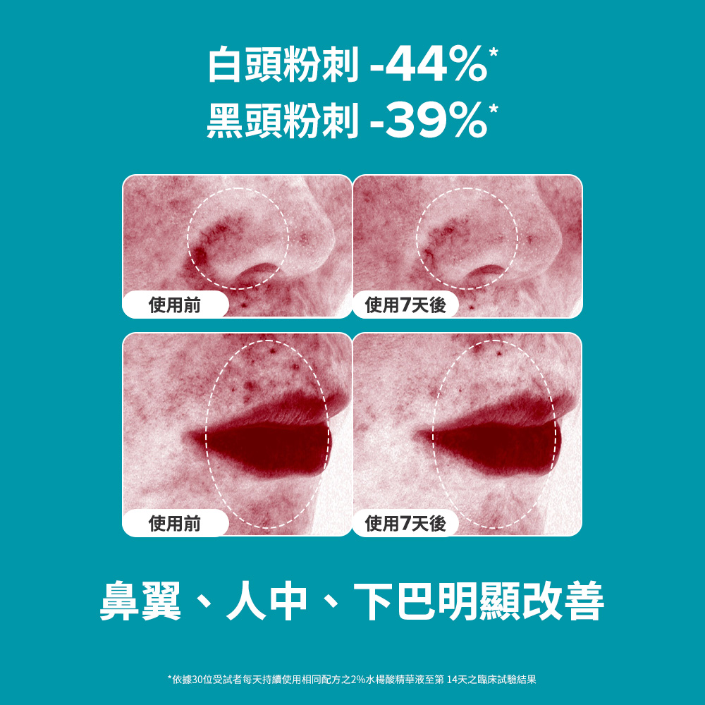 白頭粉刺-44％* 黑頭粉刺-39％* 鼻翼、人中、下巴明顯改善