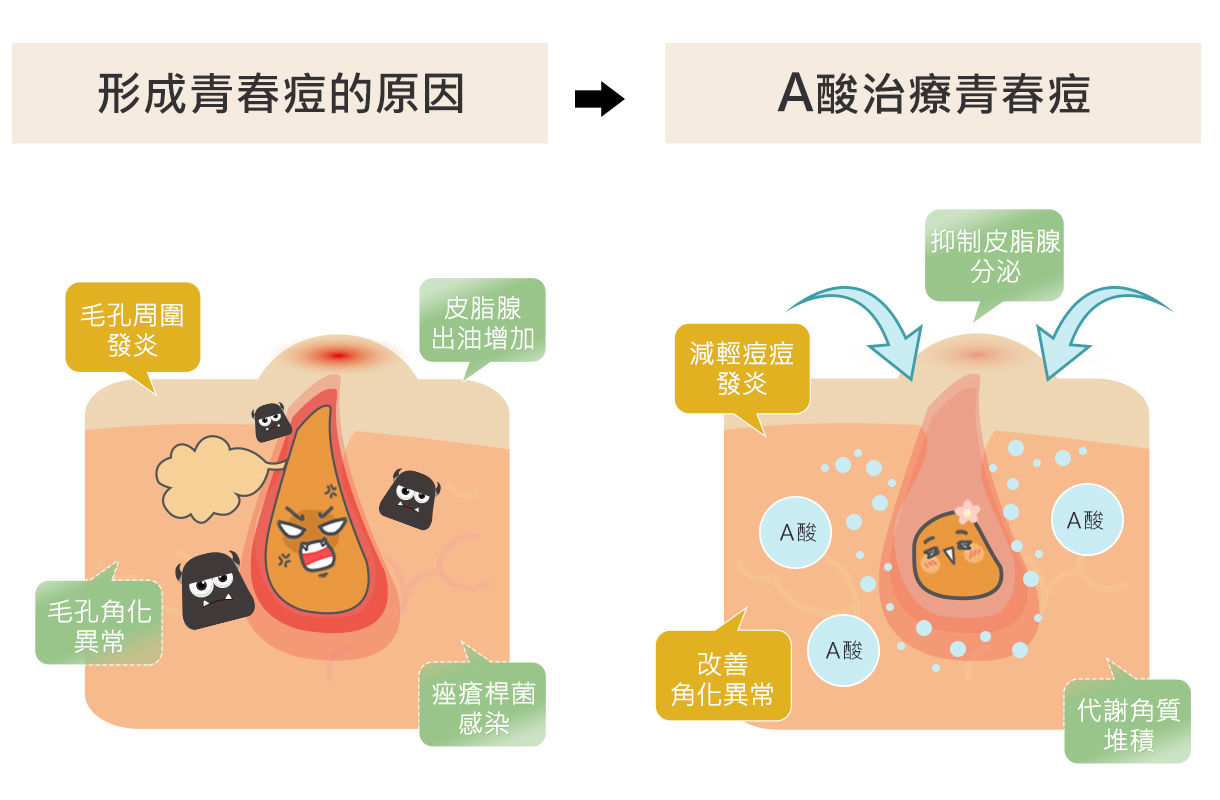 口服A酸是什麼？口服維他命A酸有副作用嗎？｜寶拉珍選